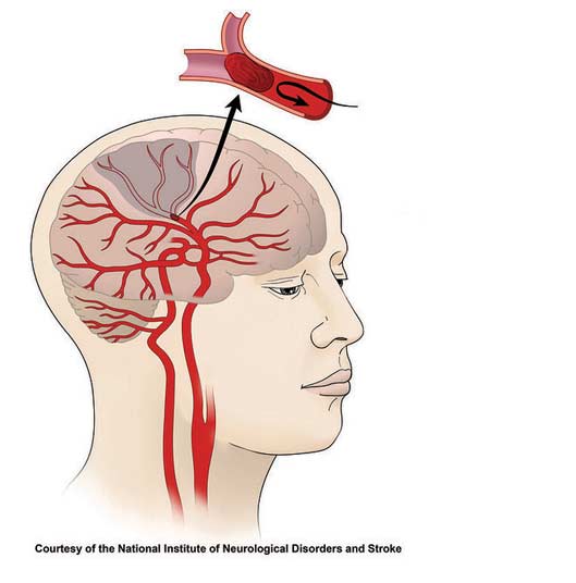 stroke recovery