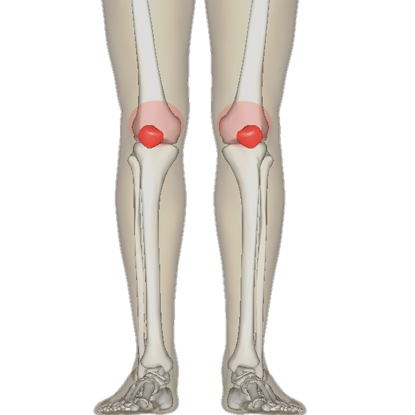 patellofemoral pain syndrome