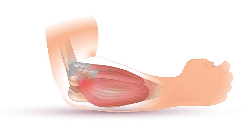 tennis elbow illustration