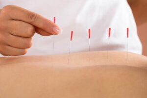 dry-needling