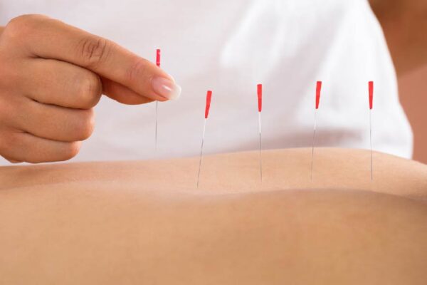 dry-needling