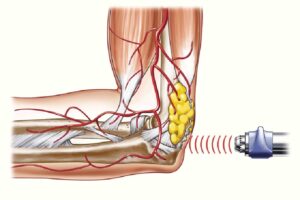 Shockwave-Therapy-vs-Class-4-Laser-Therapy