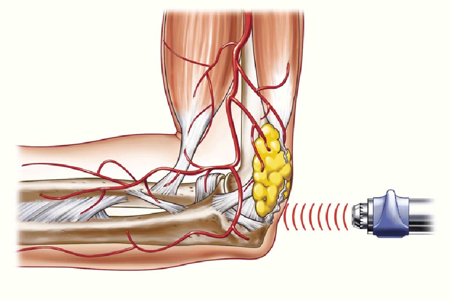 Shockwave-Therapy-vs-Class-4-Laser-Therapy