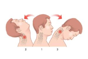 Physiotherapy-for-Whiplash-Recovery