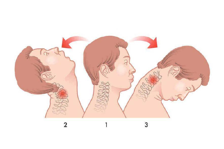 Physiotherapy-for-Whiplash-Recovery